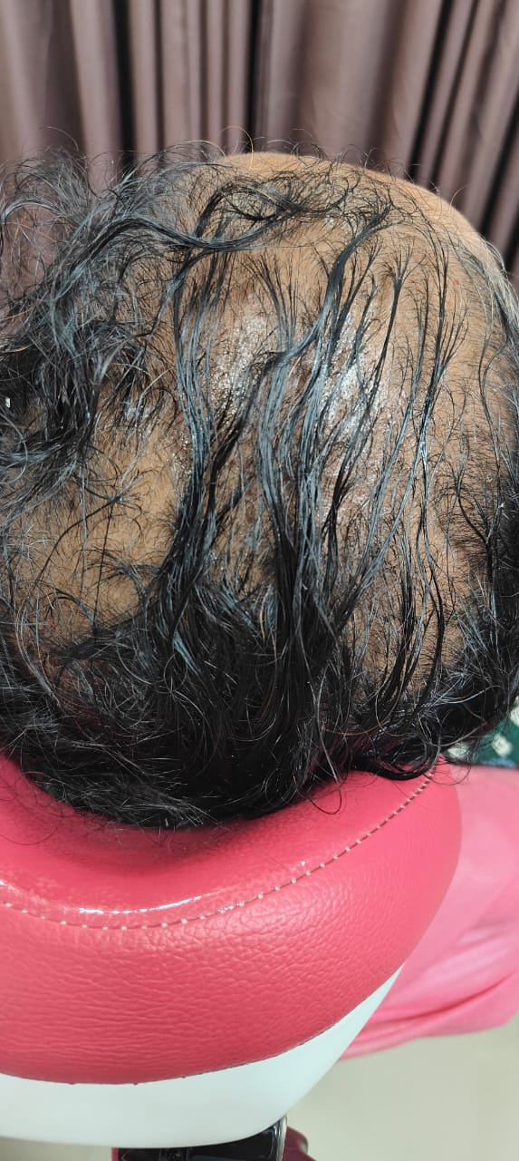 Before Treatment
