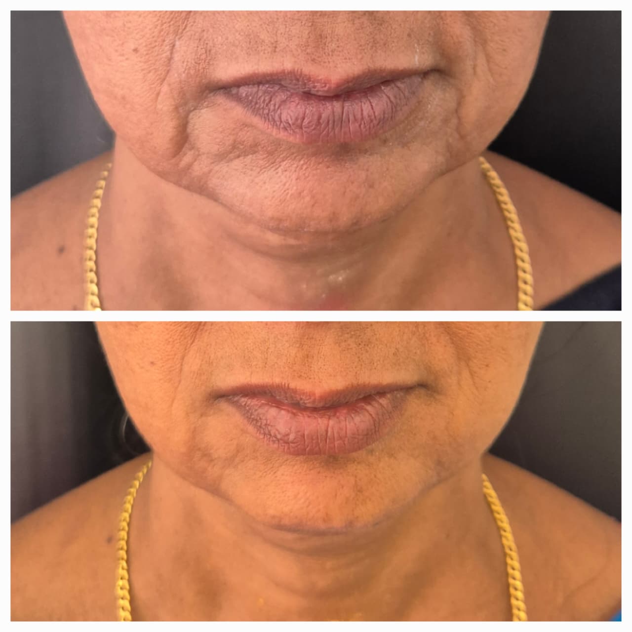 Before and After