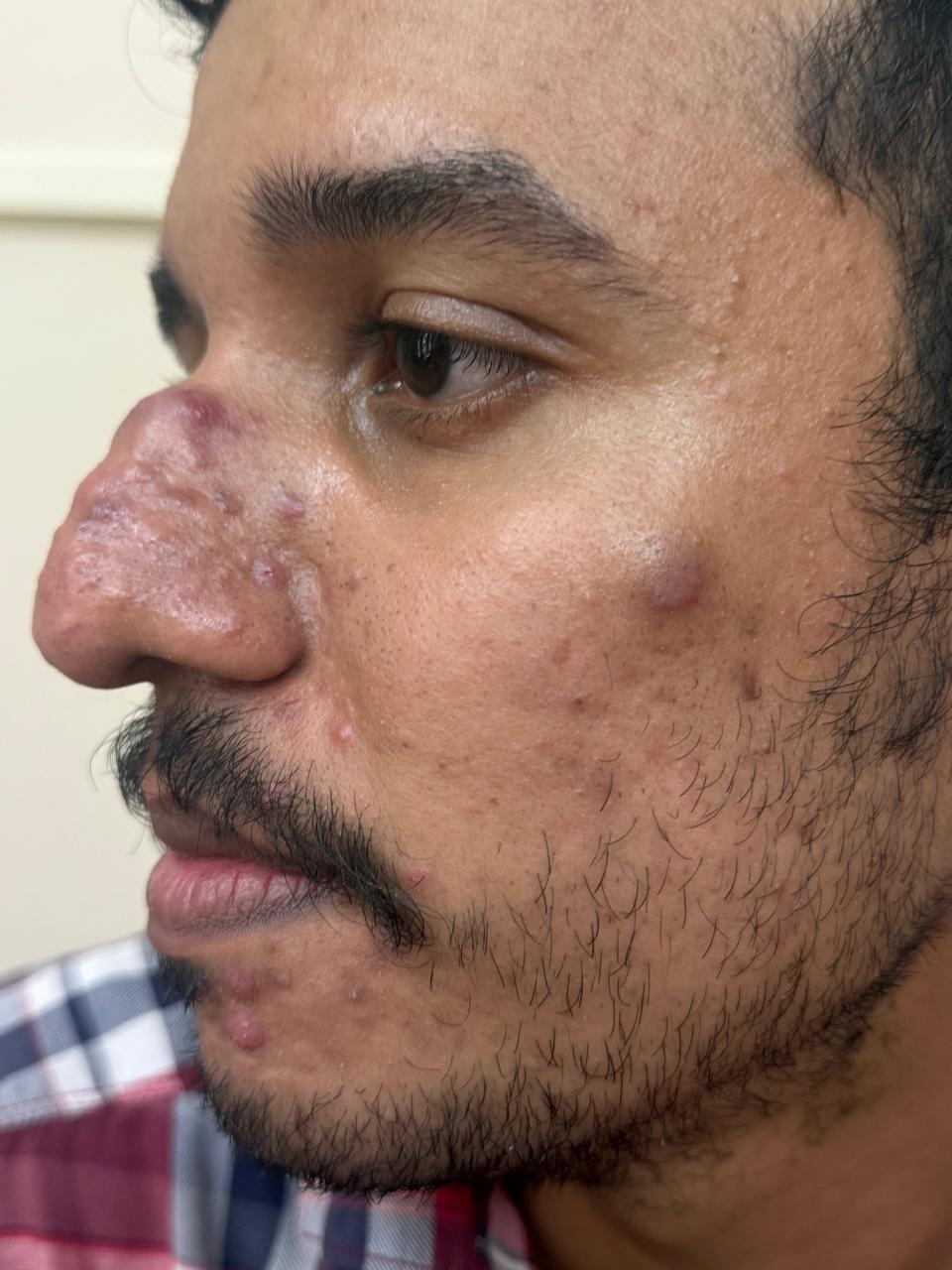 Before Treatment