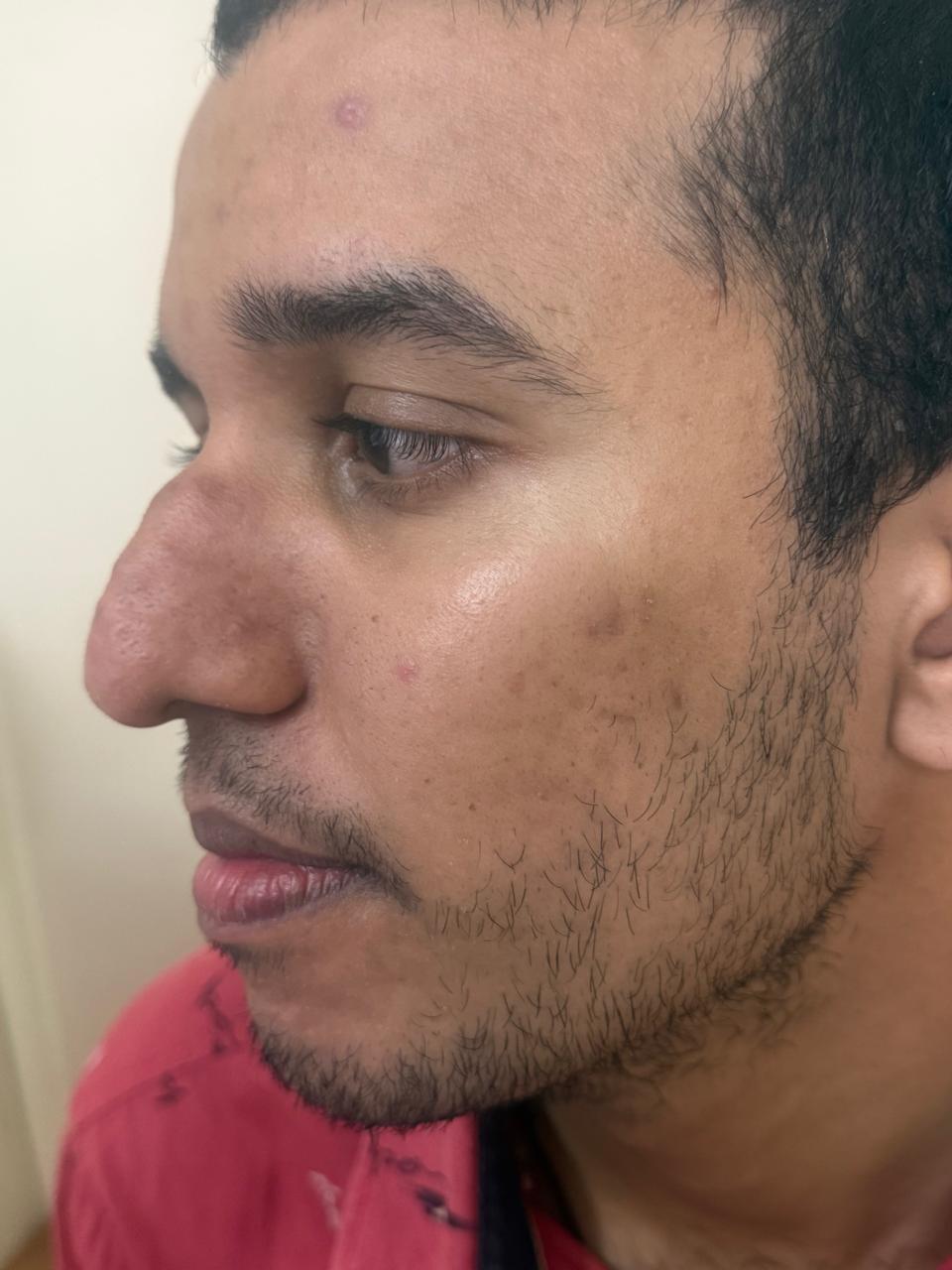 After Treatment