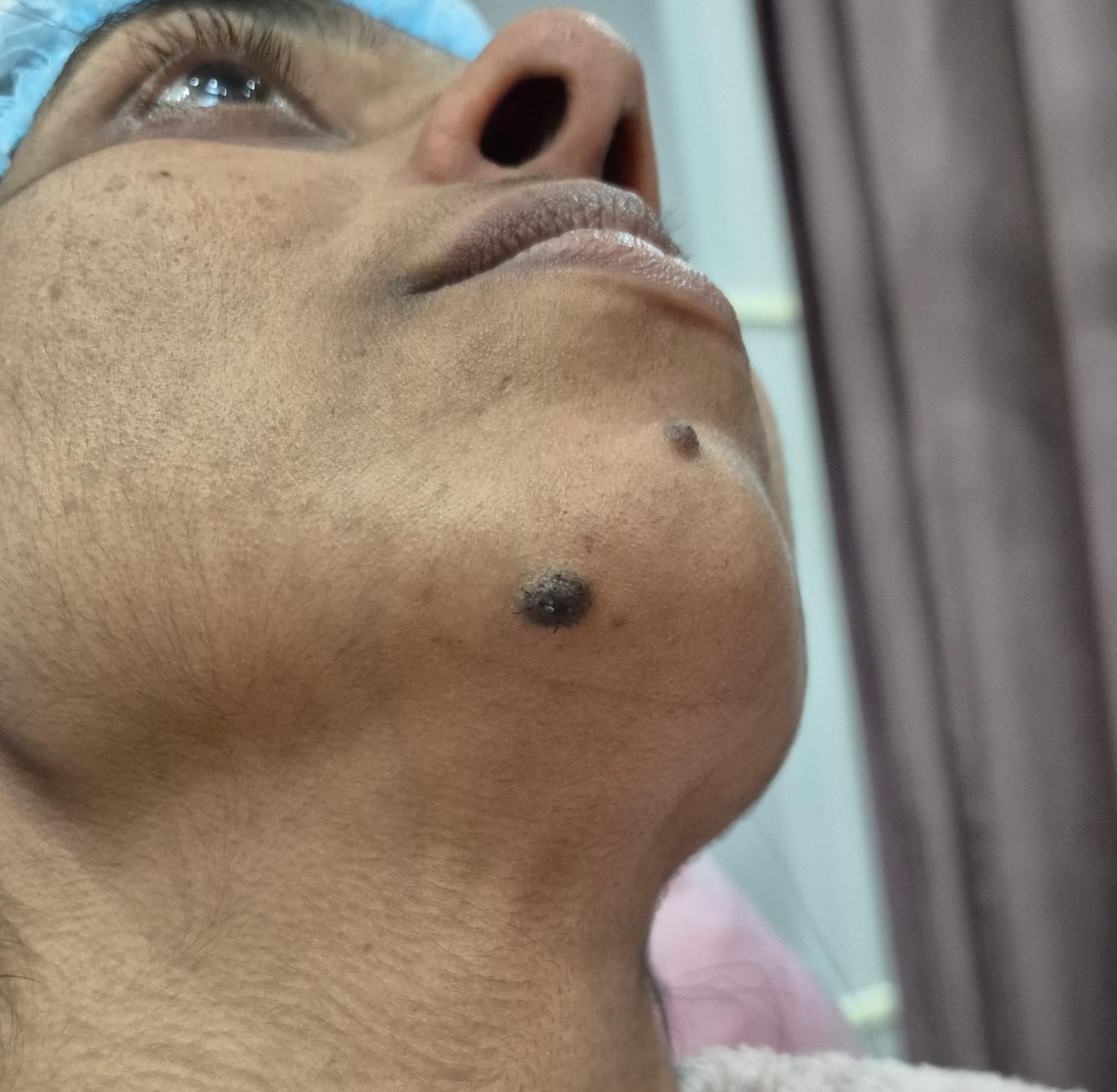 Before Treatment