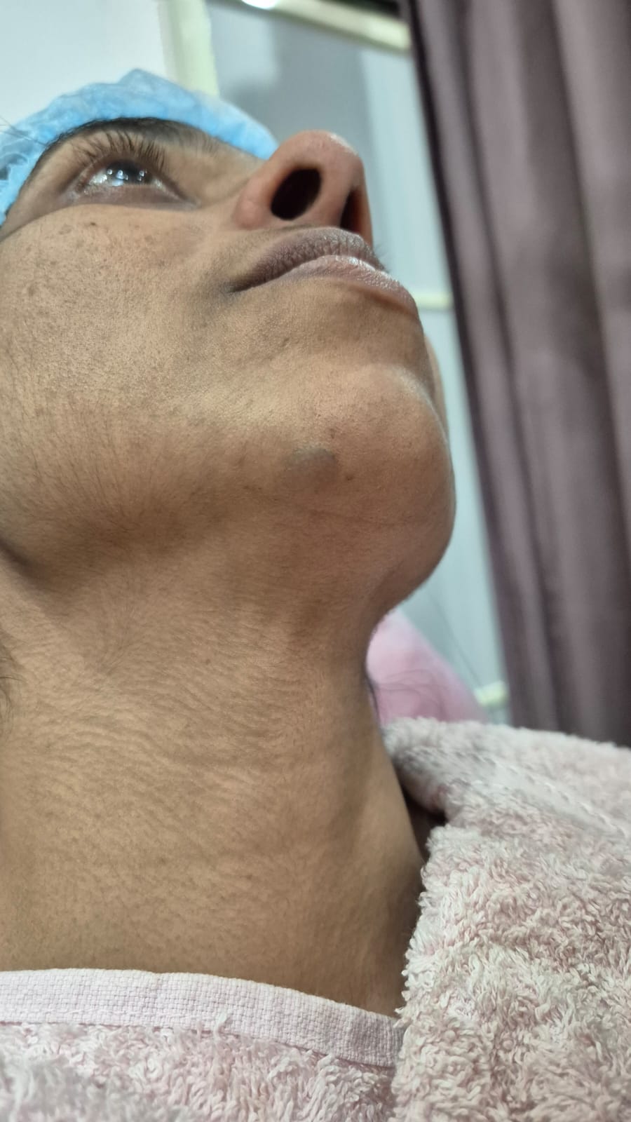 After Treatment