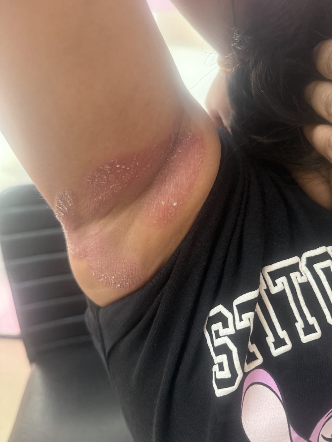 Before Treatment