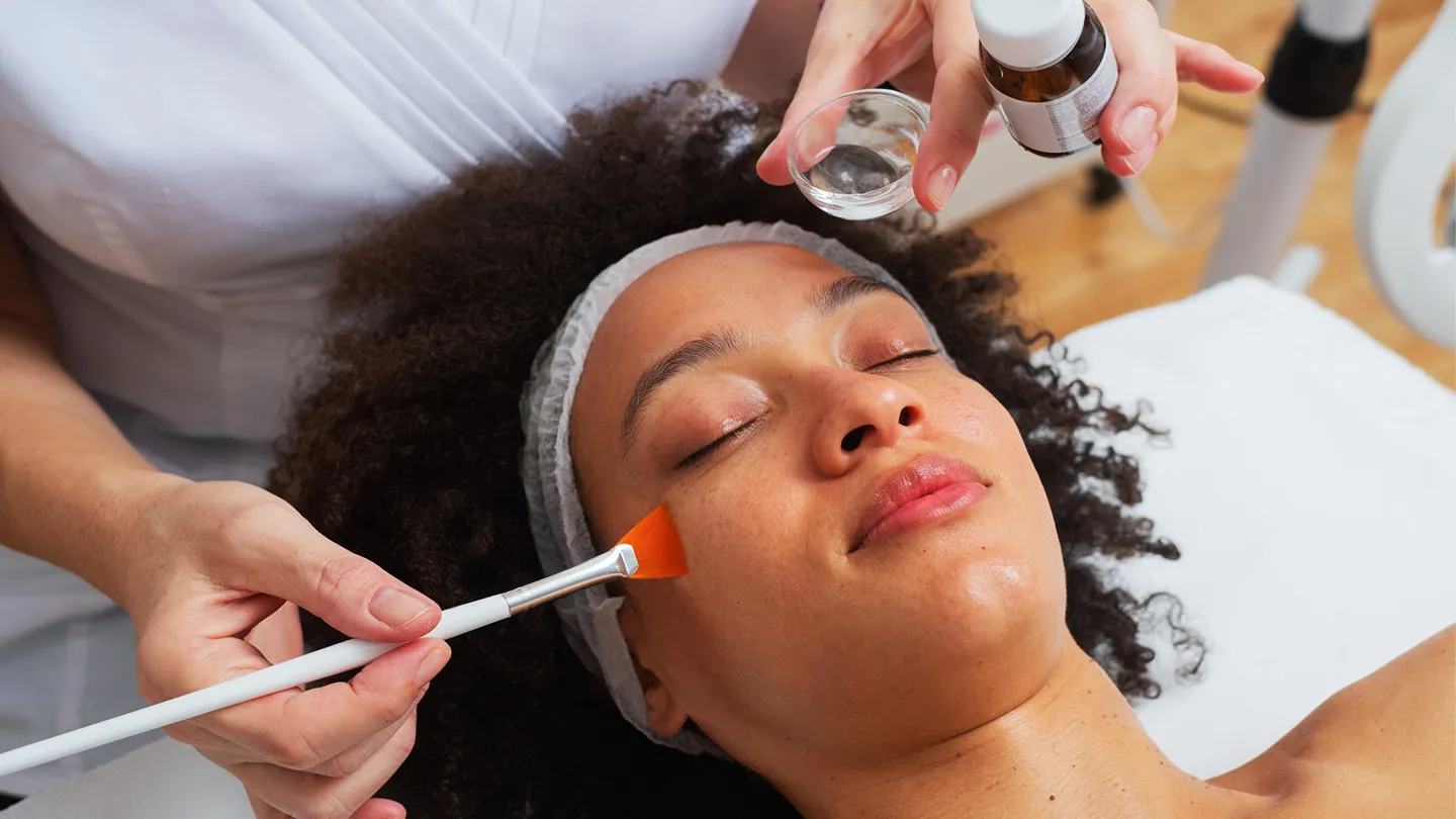Chemical Peel Story
