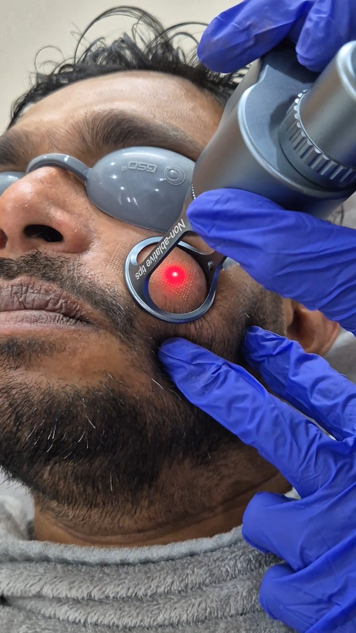 CO2 Fractional Laser Story